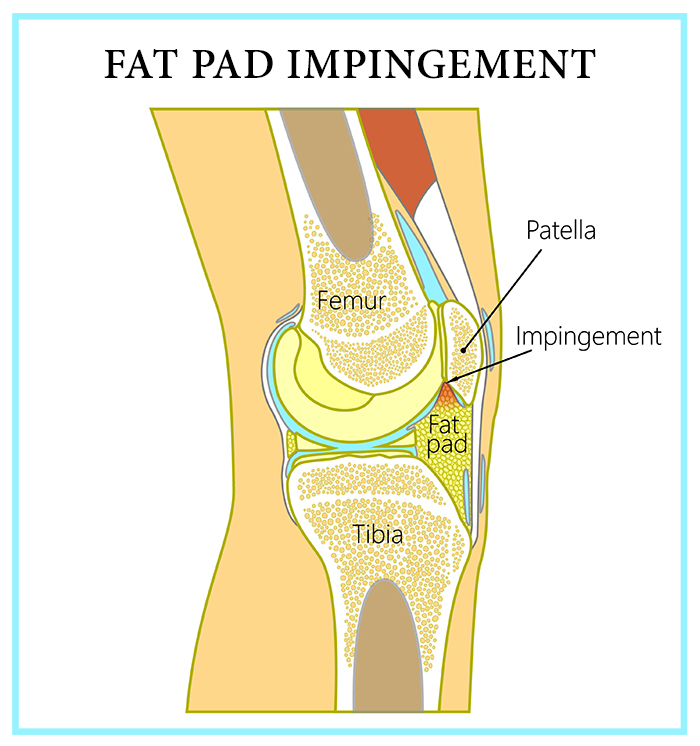 Fat on sale pad impingement